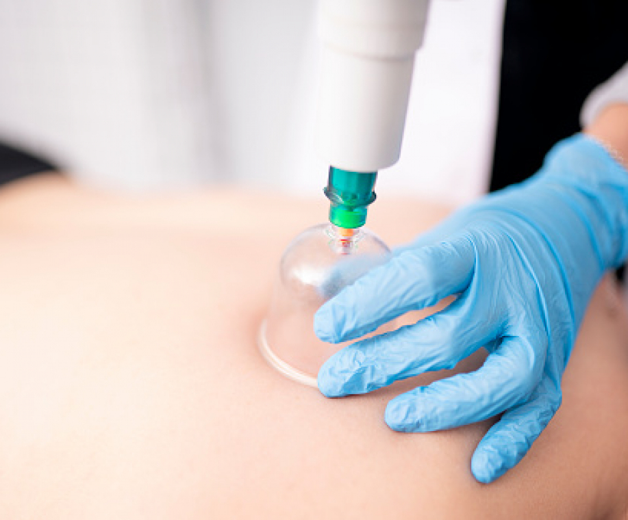 best hijama clinic in dubai
