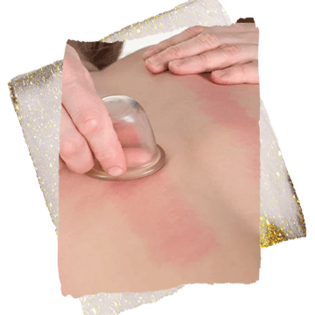 best hijama clinic in dubai