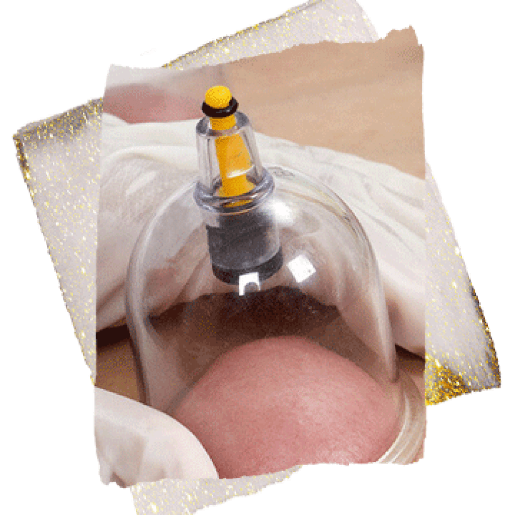 hijama in dubai