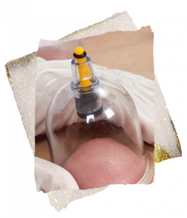 hijama in dubai