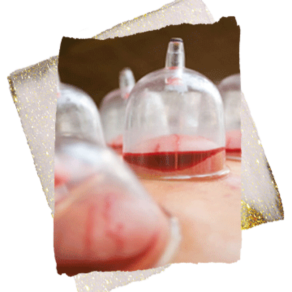 best hijama clinic in dubai