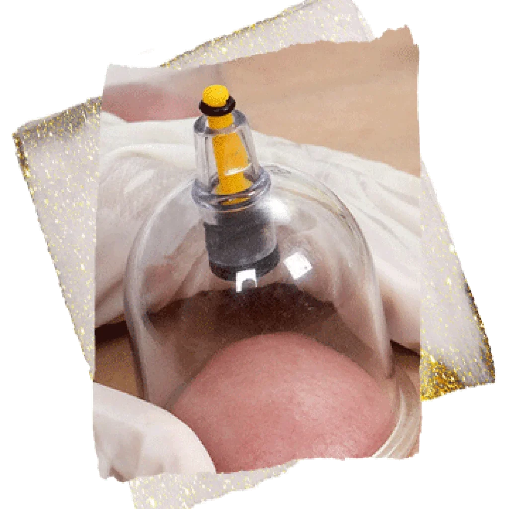 Cupping-Precautions-1024x1024