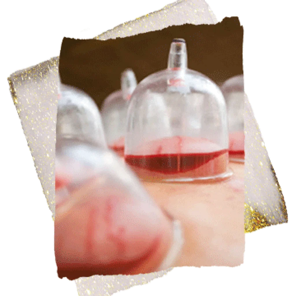 hijama