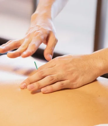 cupping therapy